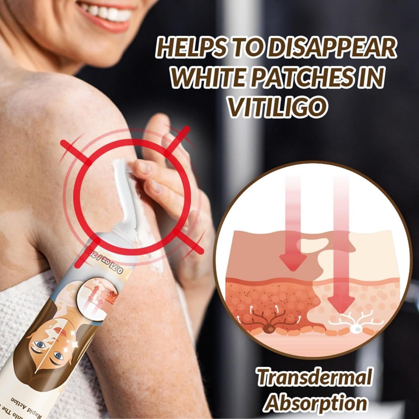 Vitiligo Removal Cream